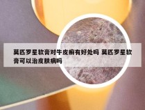 莫匹罗星软膏对牛皮癣有好处吗 莫匹罗星软膏可以治皮肤病吗