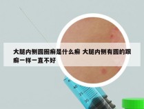 大腿内侧圆圈癣是什么癣 大腿内侧有圆的跟癣一样一直不好