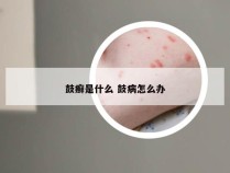 鼓癣是什么 鼓病怎么办