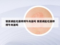 银屑病能吃康师傅牛肉面吗 银屑病能吃康师傅牛肉面吗