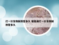 打一针生物制剂管多久 银屑病打一针生物制剂管多久