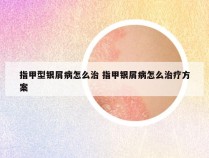 指甲型银屑病怎么治 指甲银屑病怎么治疗方案