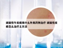 顽固性午皮癣用什么外用药物治疗 顽固性皮癣怎么治疗土方法