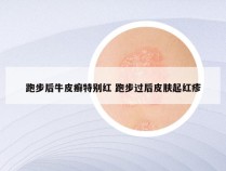 跑步后牛皮癣特别红 跑步过后皮肤起红疹