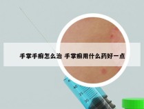 手掌手癣怎么治 手掌癣用什么药好一点