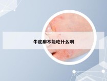 牛皮癣不能吃什么啊