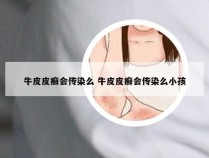 牛皮皮癣会传染么 牛皮皮癣会传染么小孩