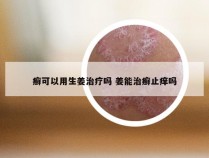 癣可以用生姜治疗吗 姜能治癣止痒吗