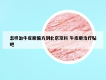 怎样治牛皮廨偏方到北京京科 牛皮廨治疗贴吧