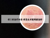 疥廯的治疗办法 疥怎么才能彻底治好