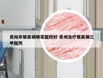 贵阳市银屑病哪家医院好 贵州治疗银屑病三甲医院