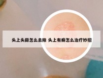 头上头藓怎么去除 头上有癣怎么治疗妙招