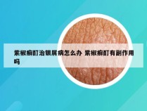 紫椒癣酊治银屑病怎么办 紫椒癣酊有副作用吗