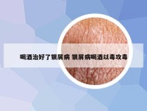 喝酒治好了银屑病 银屑病喝酒以毒攻毒