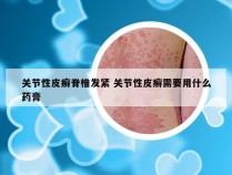 关节性皮癣脊椎发紧 关节性皮癣需要用什么药膏