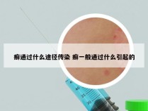 癣通过什么途径传染 癣一般通过什么引起的