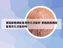 掌跖脓疱病反复发作几次能好 掌跖脓疱病反复发作几次能好吗