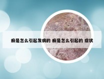 癣是怎么引起发病的 癣是怎么引起的 症状