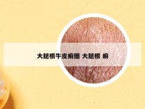 大腿根牛皮癣图 大腿根 癣