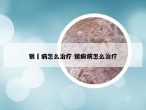 银痟病怎么治疗 银癣病怎么治疗