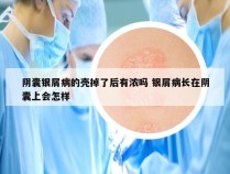 阴囊银屑病的壳掉了后有浓吗 银屑病长在阴囊上会怎样