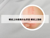 眼皮上长癣用什么药膏 眼皮上涨癣