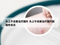 头上牛皮廨治疗图片 头上牛皮廨治疗图片腻脂性皮炎