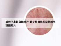 后脖子上长白圈图片 脖子后面很多白色的小斑圈照片