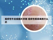 疱疹性牛皮癣图片早期 疱疹性银屑病用什么药