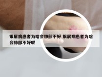 银屑病患者为啥会肺部不好 银屑病患者为啥会肺部不好呢