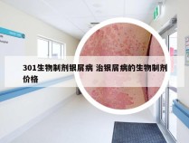 301生物制剂银屑病 治银屑病的生物制剂价格