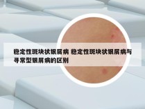 稳定性斑块状银屑病 稳定性斑块状银屑病与寻常型银屑病的区别