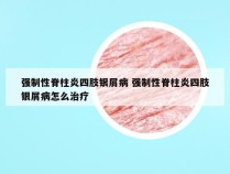 强制性脊柱炎四肢银屑病 强制性脊柱炎四肢银屑病怎么治疗