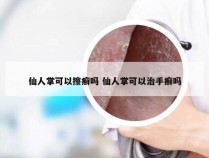 仙人掌可以擦癣吗 仙人掌可以治手癣吗