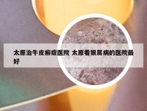 太原治牛皮癣症医院 太原看银屑病的医院最好