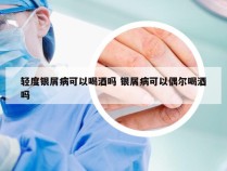 轻度银屑病可以喝酒吗 银屑病可以偶尔喝酒吗