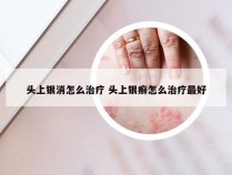 头上银消怎么治疗 头上银癣怎么治疗最好