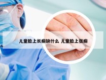 儿童脸上长癣缺什么 儿童脸上张癣