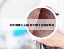 郑州哪里治头癣 郑州哪个医院看癣好