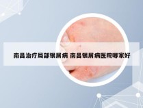 南昌治疗局部银屑病 南昌银屑病医院哪家好