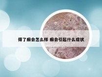 得了癣会怎么样 癣会引起什么症状