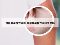 银屑病与慢性湿疹 银屑病与慢性湿疹有关吗