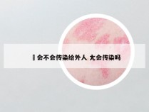 廯会不会传染给外人 尢会传染吗