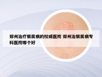 郑州治疗银屑病的权威医院 郑州治银屑病专科医院哪个好