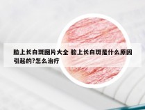 脸上长白斑图片大全 脸上长白斑是什么原因引起的?怎么治疗