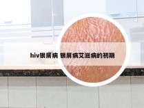 hiv银屑病 银屑病艾滋病的初期