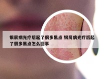 银屑病光疗后起了很多黑点 银屑病光疗后起了很多黑点怎么回事