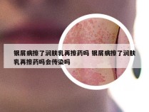 银屑病擦了润肤乳再擦药吗 银屑病擦了润肤乳再擦药吗会传染吗