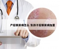 产后银屑病怎么 生孩子后银屑病加重