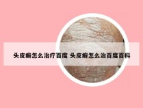 头皮癣怎么治疗百度 头皮癣怎么治百度百科